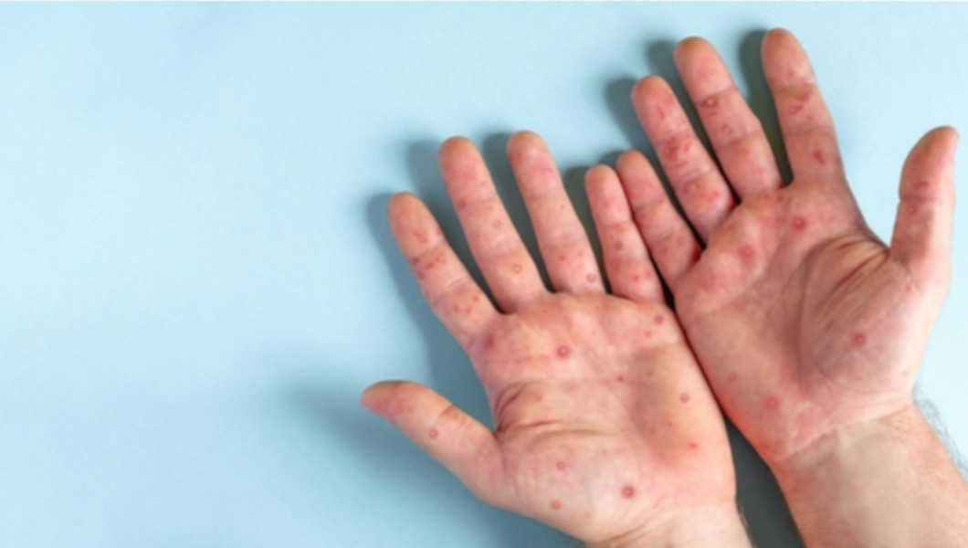 La variole du singe ou mpox : connaître la maladie | Crédit photo : AlloDocteur